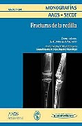 Fracturas de la rodilla, 2